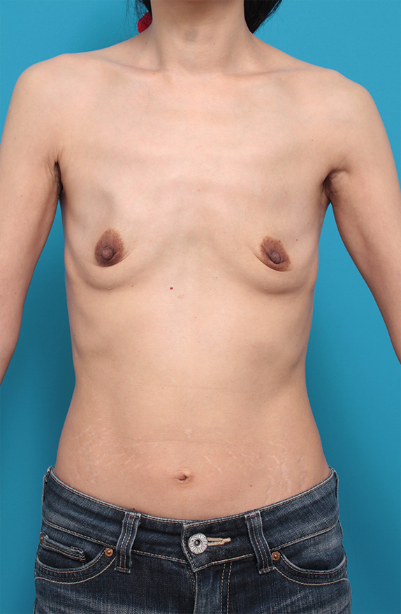 マンマリーヒアル（R）（プチ豊胸術・ヒアルロン酸豊胸術）,マンマリーヒアル(R)（プチ豊胸術・ヒアルロン酸豊胸術）の症例 元々体型がスリムな女性,Before,ba_mammary49_b.jpg