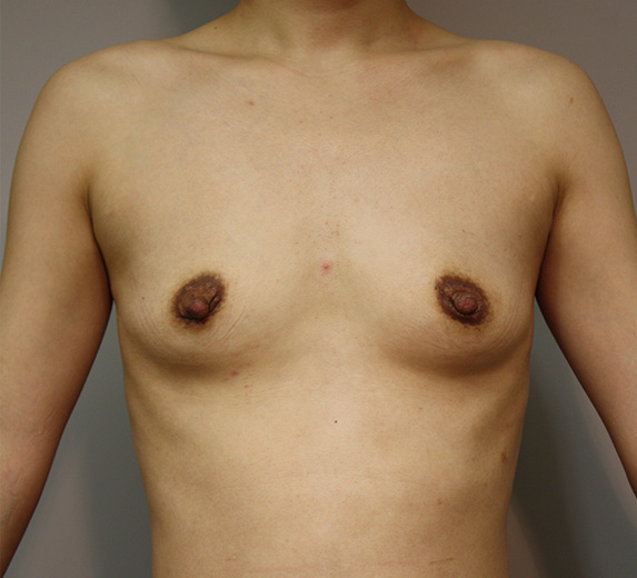 症例写真,マンマリーヒアル(R)（プチ豊胸術・ヒアルロン酸豊胸術）の症例 胸が垂れていることを気にしていた30代女性,Before,ba_mammary_pic30_b.jpg