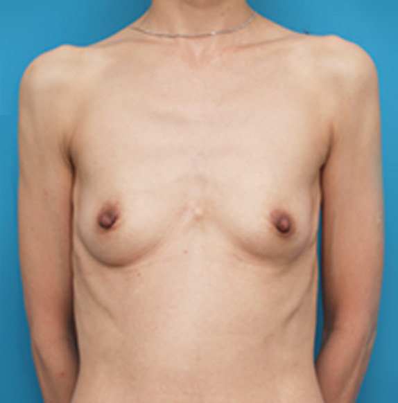 マンマリーヒアル（R）（プチ豊胸術・ヒアルロン酸豊胸術）,マンマリーヒアル(R)（プチ豊胸術・ヒアルロン酸豊胸術）の症例 授乳によってしぼんでしまった50代女性,Before,ba_mammary_pic24_b.jpg