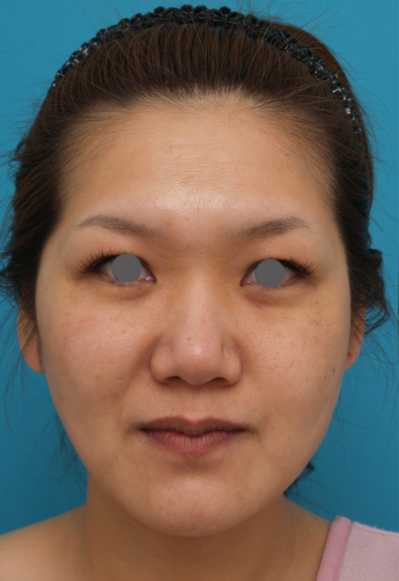 症例写真,ウルセラシステムの症例 目尻や頬のたるみ肌の張りのなさが気になる30代女性,After,ba_ulthera_pic08_b.jpg