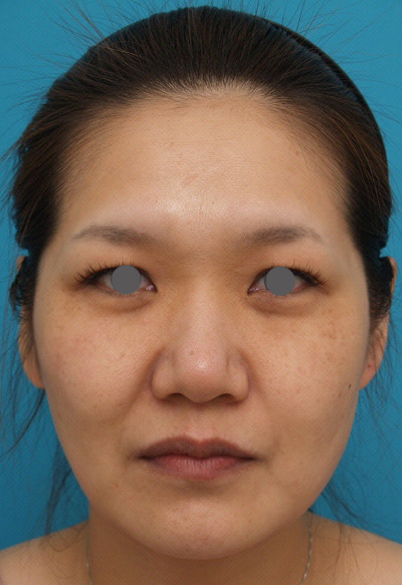 ウルセラシステム,ウルセラシステムの症例 目尻や頬のたるみ肌の張りのなさが気になる30代女性,Before,ba_ulthera_pic08_b.jpg