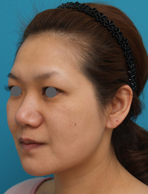 症例写真,ウルセラシステムの症例 目尻や頬のたるみ肌の張りのなさが気になる30代女性,After,ba_ulthera_pic09_b.jpg