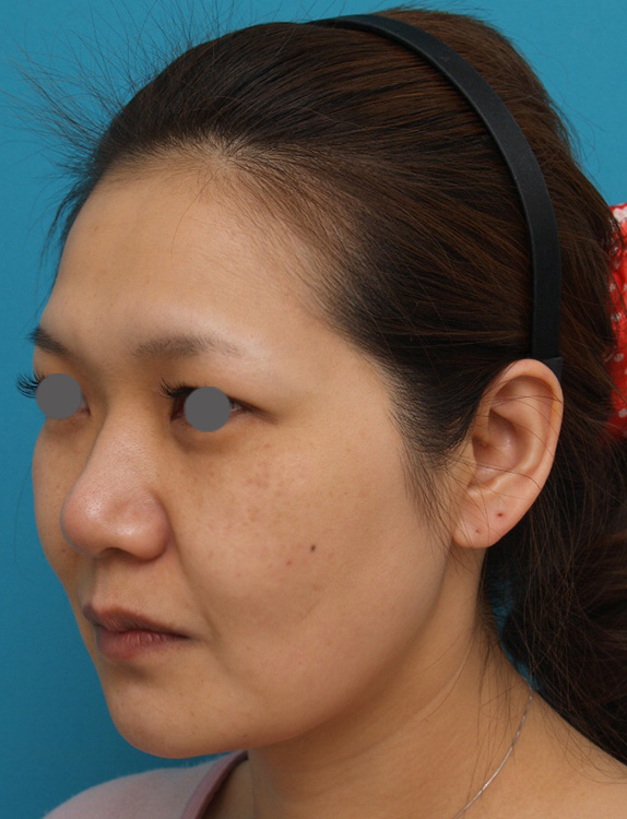 症例写真,ウルセラシステムの症例 目尻や頬のたるみ肌の張りのなさが気になる30代女性,Before,ba_ulthera_pic09_b.jpg