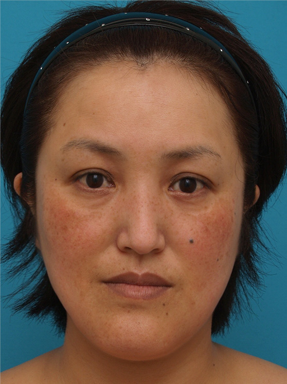 二重あご改善,ウルセラシステムの症例 コメカミ、目尻、頬のたるみや二重あごが悩みの40代女性,After,ba_ulthera_pic12_b.jpg