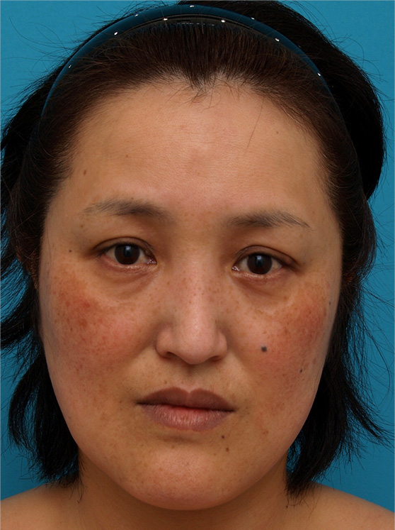 二重あご改善,ウルセラシステムの症例 コメカミ、目尻、頬のたるみや二重あごが悩みの40代女性,Before,ba_ulthera_pic12_b.jpg