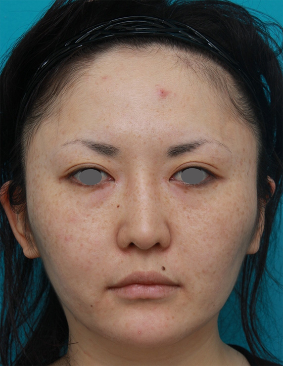 症例写真,20代女性にウルセラシステムを行い、顔が引き締まって小顔になった症例写真,Before,ba_ulthera_pic14_b.jpg