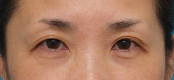 サーマクールアイ,サーマクールアイで目の周りの小じわが改善し、わずかに二重の幅が広がり、目が大きくなった症例写真,After（2ヶ月後）,ba_thermacool_eye06_a01.jpg