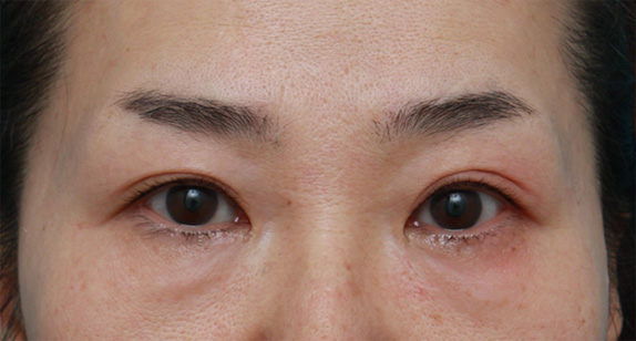 サーマクールアイ,サーマクールアイで目の開きが良くなった症例写真の術前術後画像の解説,After（2ヶ月後）,ba_thermacool_eye07_a01.jpg