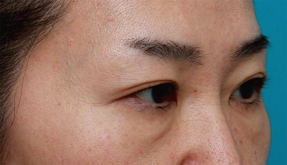 サーマクールアイ,サーマクールアイで目の開きが良くなった症例写真の術前術後画像の解説,Before,ba_thermacool_eye08_b.jpg