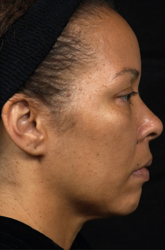 サーマクールの症例写真　顔全体、くび,After（4ヶ月後）,ba_thermacool_pic15_a01.jpg