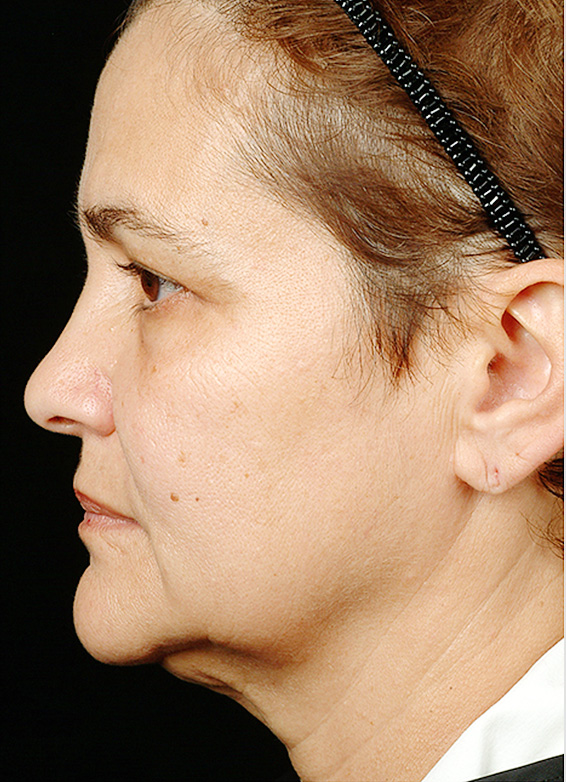 サーマクールFLXの症例 顎から首元にかけて施術を受けた女性,After,ba_thermacool_pic09_a01.jpg