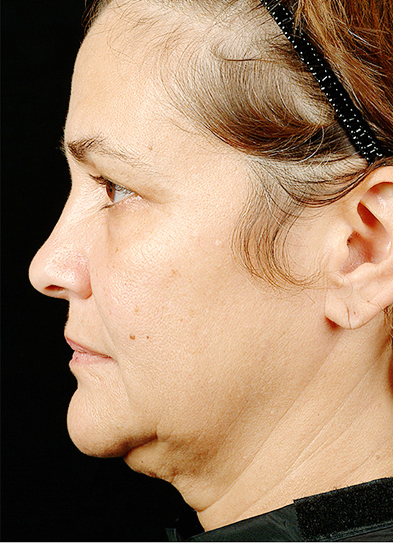 症例写真,サーマクールFLXの症例 顎から首元にかけて施術を受けた女性,Before,ba_thermacool_pic09_b.jpg