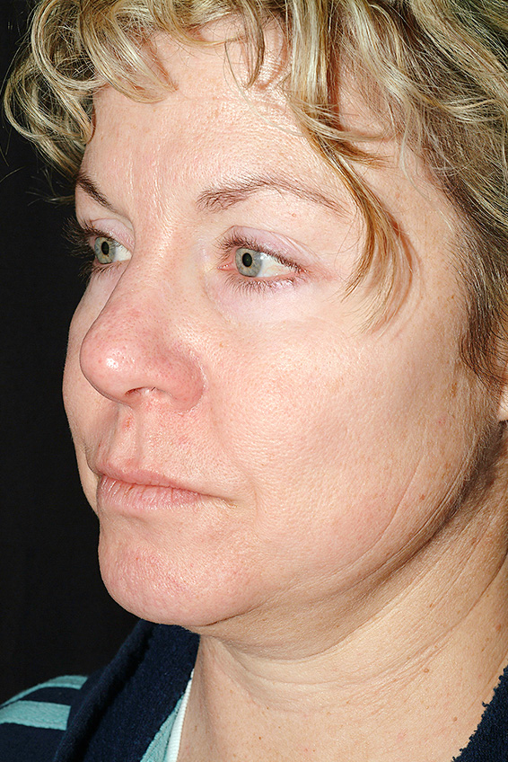 サーマクール,サーマクールFLXの症例 顔にたるみが生じていた女性,Before,ba_thermacool_pic08_b.jpg