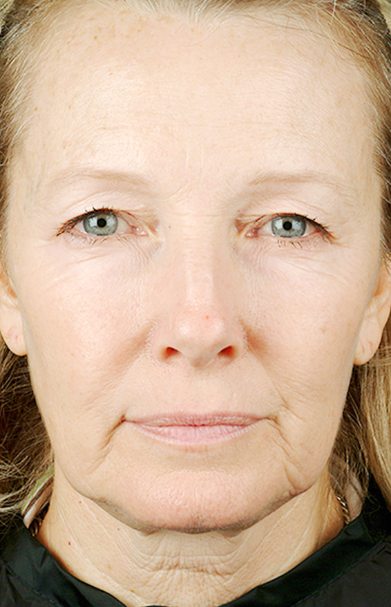 サーマクール,サーマクールFLXの症例 たるんだ頬から首もとを治療した女性,Before,ba_thermacool_pic06_b.jpg