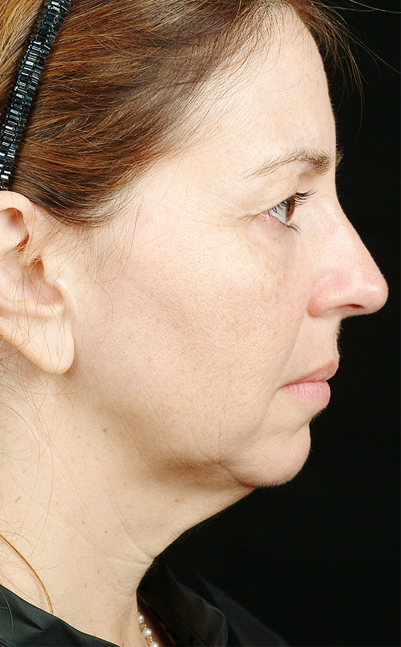 サーマクール,サーマクールFLXの症例 頬～首に大きなたるみがあった女性,After,ba_thermacool_pic05_b.jpg