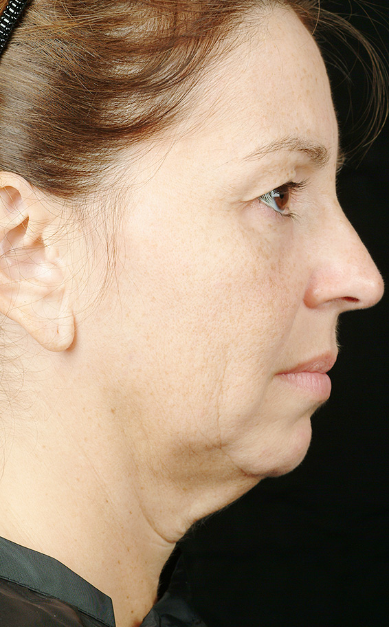 サーマクール,サーマクールFLXの症例 頬～首に大きなたるみがあった女性,Before,ba_thermacool_pic05_b.jpg