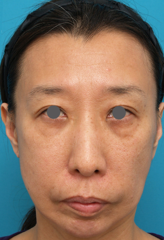 症例写真,サーマクールFLXの症例 肌にハリがなくなり口角も下がっていた女性,Before,ba_thermacool_pic25_b.jpg