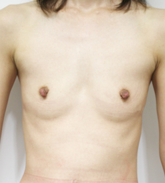マンマリーヒアル（R）（プチ豊胸術・ヒアルロン酸豊胸術）,マンマリーヒアル(R)（プチ豊胸術・ヒアルロン酸豊胸術）の症例 痩せて胸のふくらみがなかった30代女性,Before,ba_mammary_pic19_b.jpg