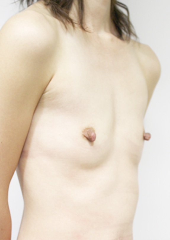 症例写真,マンマリーヒアル(R)（プチ豊胸術・ヒアルロン酸豊胸術）の症例 痩せて胸のふくらみがなかった30代女性,Before,ba_mammary_pic20_b.jpg
