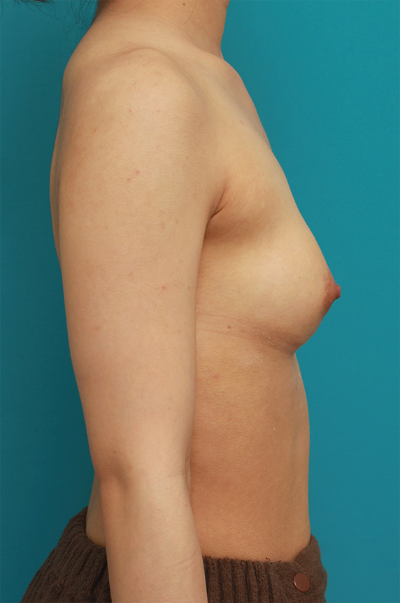 症例写真,胸がほぼ平らに近い女性に、ヒアルロン酸を50ccずつ注入し、ほどよい自然な膨らみを作った症例の術前術後画像,After（3ヶ月後）,ba_mammary59_b.jpg