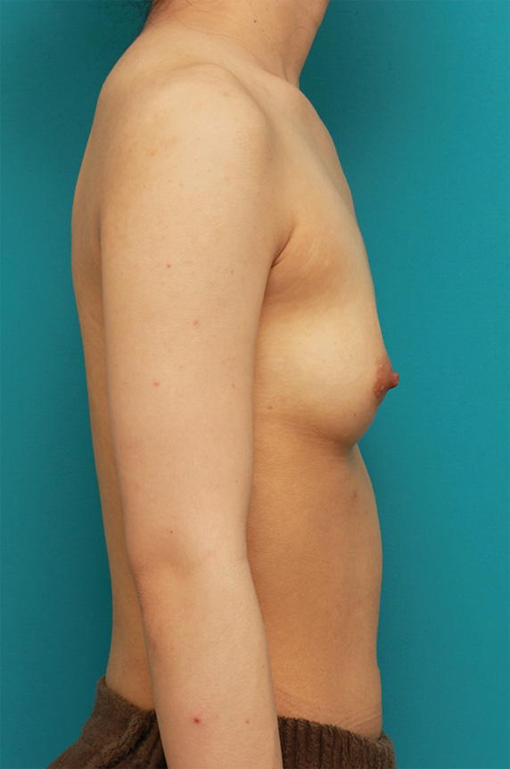 マンマリーヒアル（R）（プチ豊胸術・ヒアルロン酸豊胸術）,胸がほぼ平らに近い女性に、ヒアルロン酸を50ccずつ注入し、ほどよい自然な膨らみを作った症例の術前術後画像,Before,ba_mammary59_b.jpg