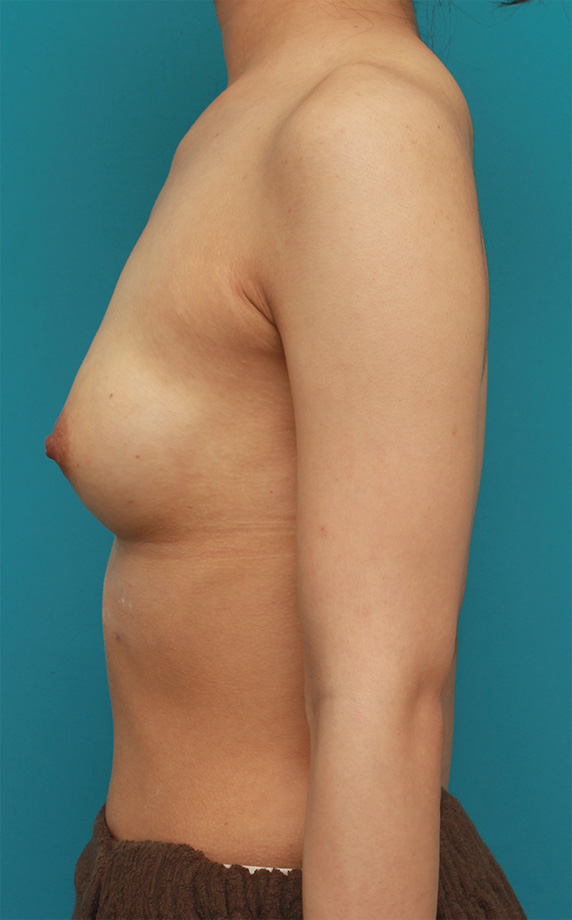マンマリーヒアル（R）（プチ豊胸術・ヒアルロン酸豊胸術）,胸がほぼ平らに近い女性に、ヒアルロン酸を50ccずつ注入し、ほどよい自然な膨らみを作った症例の術前術後画像,After（3ヶ月後）,ba_mammary61_b.jpg