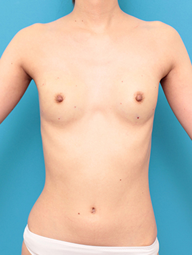 症例写真,漏斗胸もあって非常に痩せている女性の胸にヒアルロン酸を40ccずつ注射し、バストに膨らみを出した症例の術前術後画像,注射直後,mainpic_mammary06b.jpg