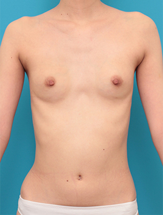 マンマリーヒアル（R）（プチ豊胸術・ヒアルロン酸豊胸術）,漏斗胸もあって非常に痩せている女性の胸にヒアルロン酸を40ccずつ注射し、バストに膨らみを出した症例の術前術後画像,1週間後,mainpic_mammary06c.jpg