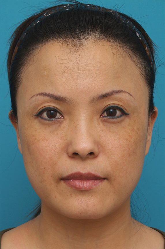 症例写真,40代女性に行ったサーマクール症例写真,After（3ヶ月後）,ba_thermacool_pic27_b.jpg