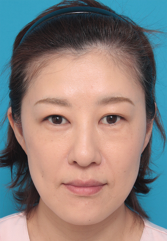 サーマクール,40代女性の顔と首にサーマクールを照射した症例写真,After（3ヶ月後）,ba_thermacool_pic29_b.jpg