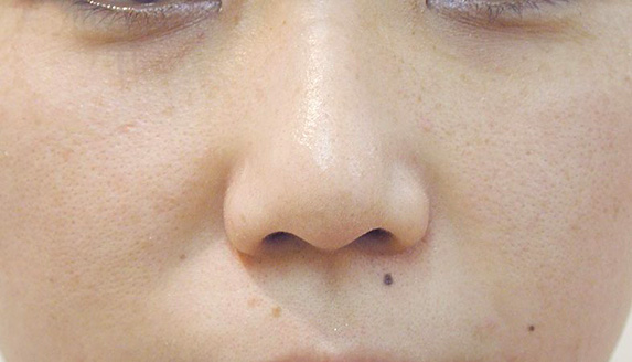 フォトフェイシャルM22,フォトフェイシャルM22の症例 頬に点在するシミやそばかすを気にされていた患者様,After,ba_rf_04_a01.jpg