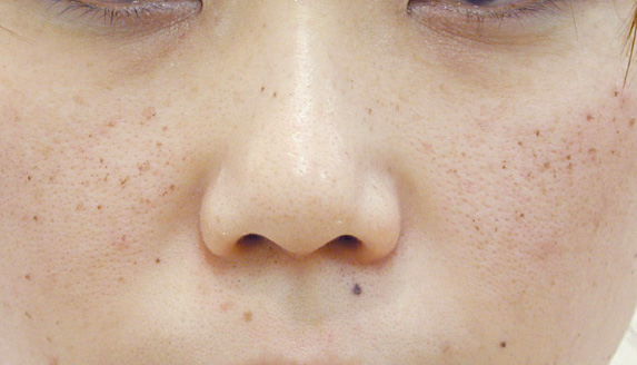 フォトフェイシャルM22,フォトフェイシャルM22の症例 頬に点在するシミやそばかすを気にされていた患者様,Before,ba_rf_04_b.jpg
