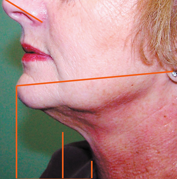 フォトフェイシャルM22,フォトフェイシャルM22の症例　顔、首の治療,After,ba_rf_07_b.jpg