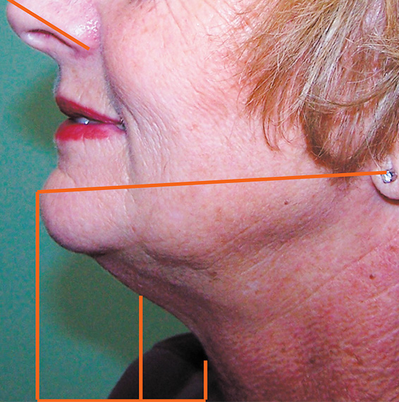 フォトフェイシャルM22,フォトフェイシャルM22の症例　顔、首の治療,Before,ba_rf_07_b.jpg