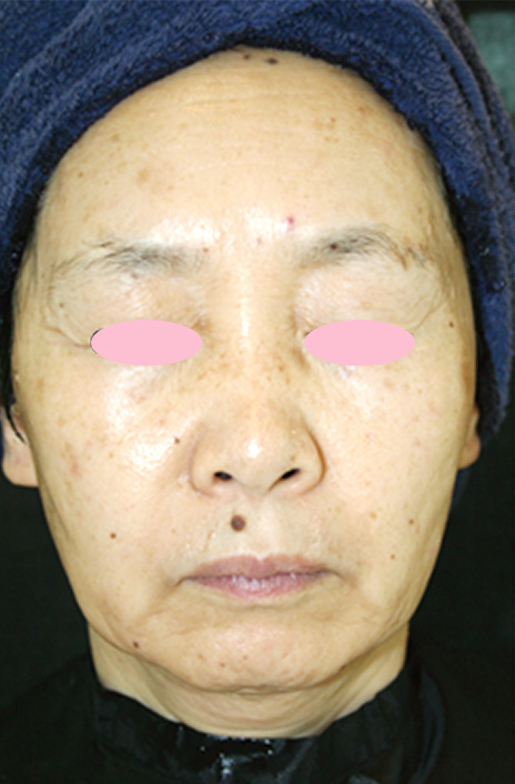 フォトフェイシャルM22,フォトフェイシャルM22 で顔全体を治療された女性の症例,After,ba_rf_06_a01.jpg