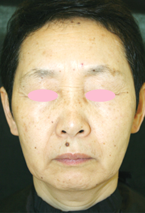 フォトフェイシャルM22,フォトフェイシャルM22 で顔全体を治療された女性の症例,Before,ba_rf_06_b.jpg