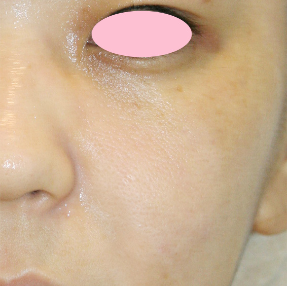 症例写真,フォトフェイシャルM22の症例 目の下のシミと口横のニキビ跡を気にされていた患者様,After,ba_rf_05_b.jpg