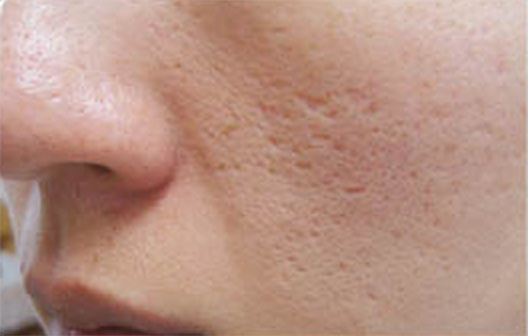 ダーマローラー（回転式皮膚点状治療）,ダーマローラー（回転式皮膚点状治療）とeマトリックスをニキビ跡の凸凹に施術した症例,Before,ba_ematrix02_b.jpg