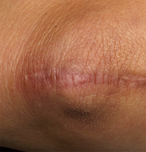 フラクセル2,フラクセル2の症例写真　膝の傷跡の治療,After,ba_flaxel_pic22_b.jpg