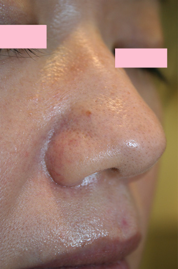 フラクセル2,フラクセル2の症例写真　鼻と鼻の周囲の毛穴の開きの治療,After,ba_flaxel_pic21_b.jpg