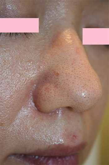 症例写真,フラクセル2の症例写真　鼻と鼻の周囲の毛穴の開きの治療,Before,ba_flaxel_pic21_b.jpg
