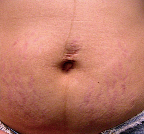 症例写真,フラクセル2の症例写真　妊娠線の治療,Before,ba_flaxel_pic20_b.jpg