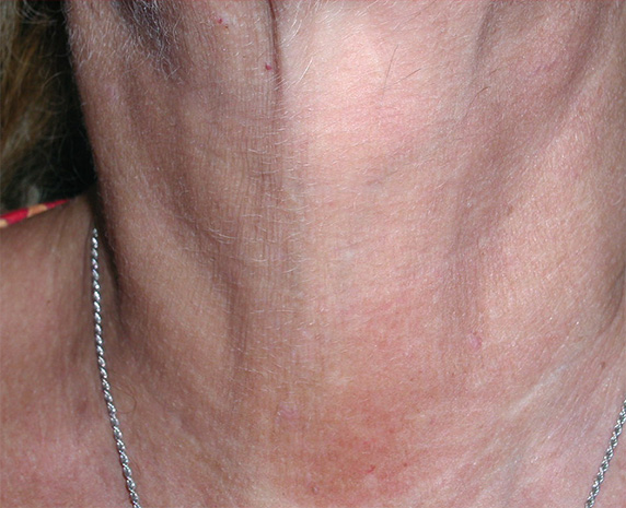 症例写真,フラクセル2の症例写真　首のシワの治療,After,ba_flaxel_pic19_b.jpg
