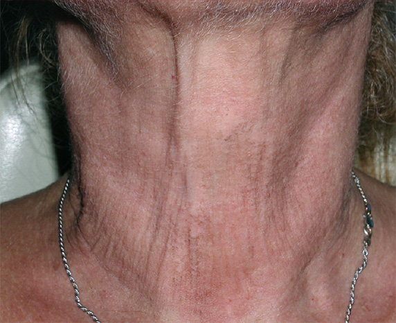 フラクセル2,フラクセル2の症例写真　首のシワの治療,Before,ba_flaxel_pic19_b.jpg