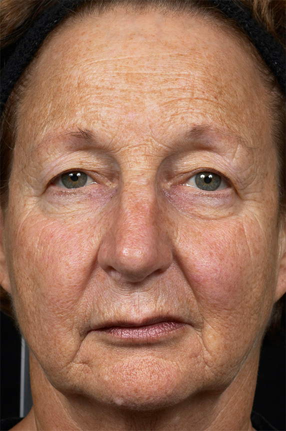 症例写真,フラクセル2　顔全体の小じわ治療の症例写真２,Before,ba_flaxel_pic15_b.jpg