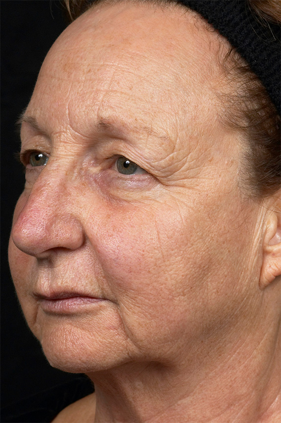 症例写真,フラクセル2　顔全体の小じわ治療の症例写真２,After（1ヶ月後）,ba_flaxel_pic16_b.jpg