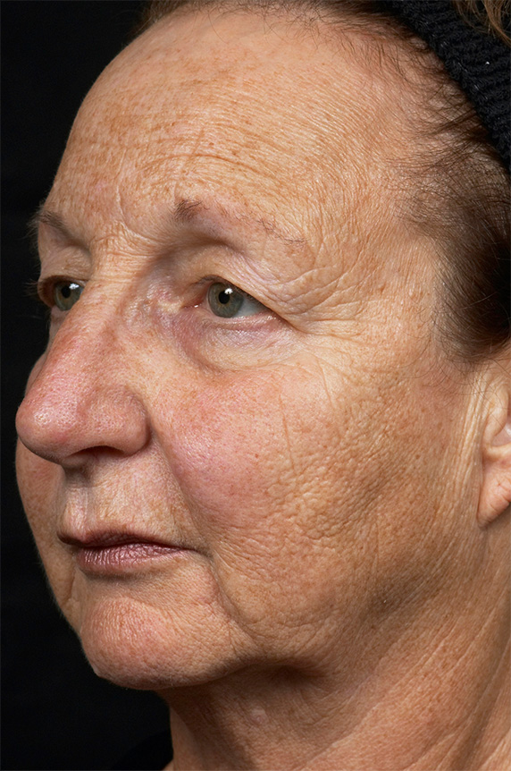 症例写真,フラクセル2　顔全体の小じわ治療の症例写真２,Before,ba_flaxel_pic16_b.jpg