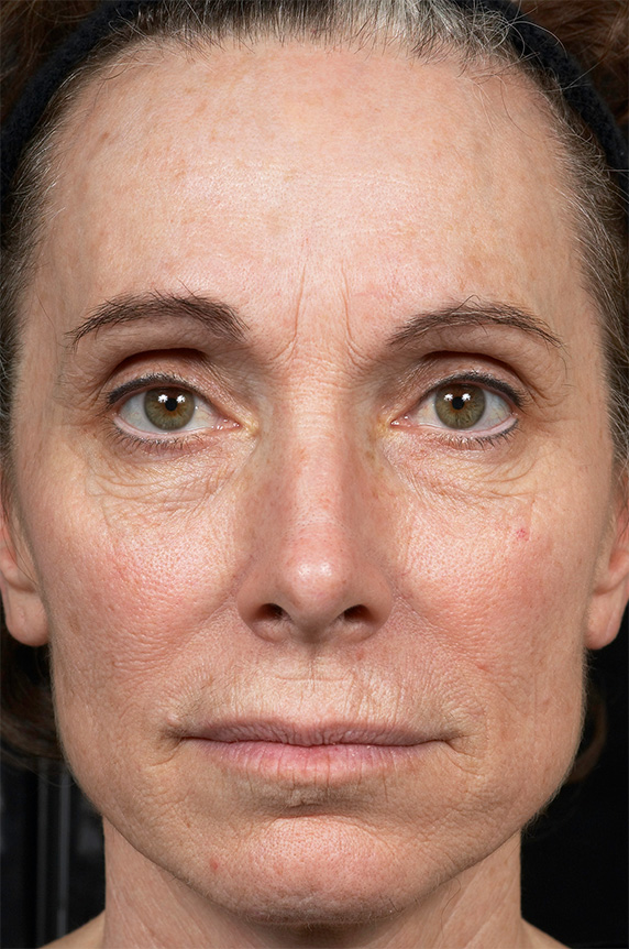 症例写真,フラクセル2　顔全体の小じわ治療の症例写真１,After（1ヶ月後）,ba_flaxel_pic14_b.jpg