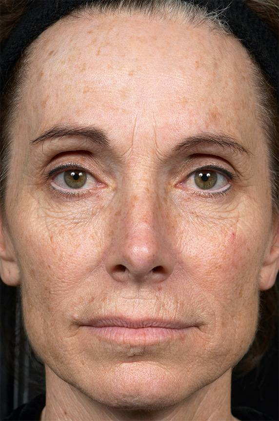 フラクセル2,フラクセル2　顔全体の小じわ治療の症例写真１,Before,ba_flaxel_pic14_b.jpg