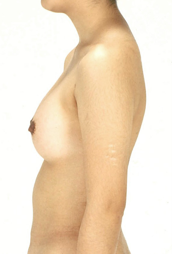 症例写真,ピュアコンデンス脂肪注入豊胸の症例 お腹と太ももから脂肪吸引してバストへ,After,ba_inject13_b.jpg